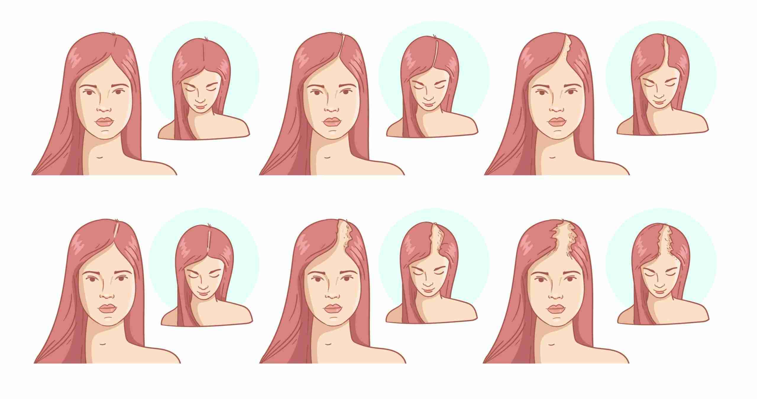 Female Pattern Baldness illustration showing female pattern baldness