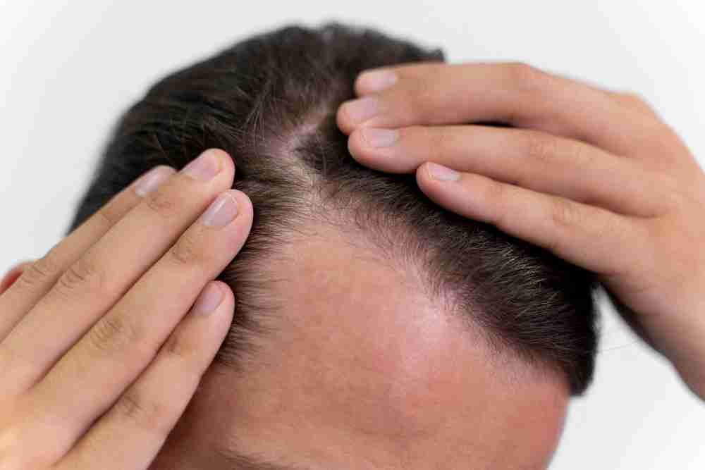 Thinning Hairline on man Man noticing his thinning hairline