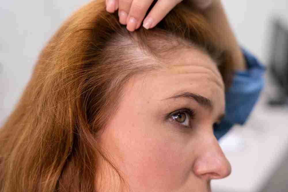 Thinning Hairline on woman Woman noticing her hairline is thinning